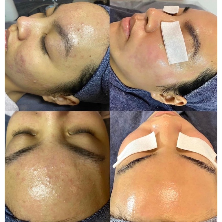 Peel III & peel IV - Tẩy da chết hoá học HL Always Active 100ml