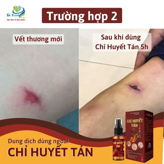 Dung Dịch Xịt Vết Thương Chỉ Huyết Tán