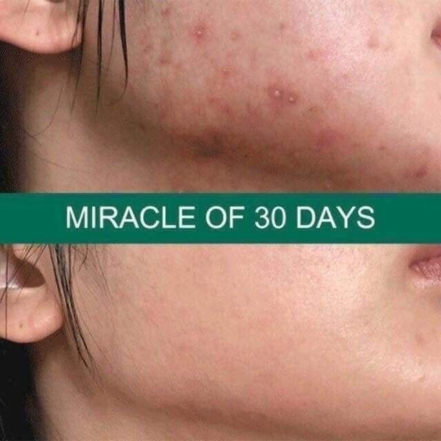 Kem dưỡng da ngừa mụn AHA.BHA.PHA 30 Days Miracle Cream.