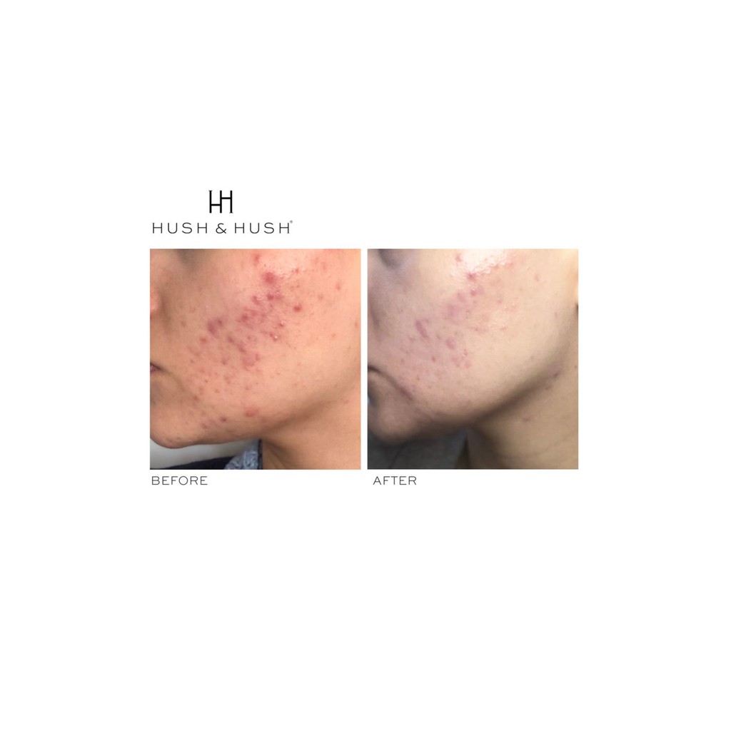 Viên uống giúp giải quyết triệt để vấn đề da mụn Hush &amp; Hush SkinCapsule Clear+ 60 viên