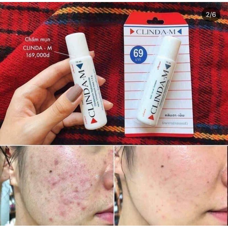 Chấm mụn Clinda - M