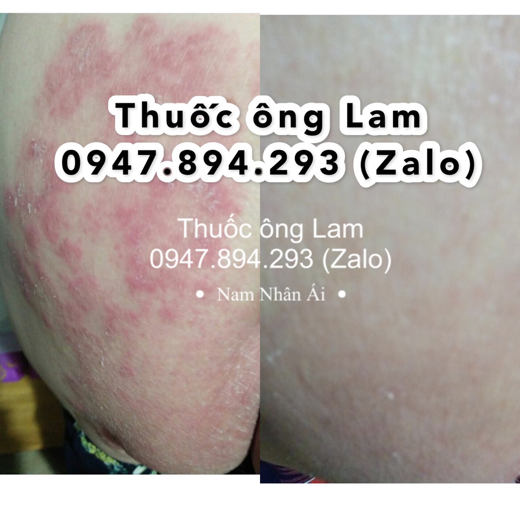 Hắc lào, nấm bẹn dứt điểm Đông Y gia truyền Ông Lam | WebRaoVat - webraovat.net.vn