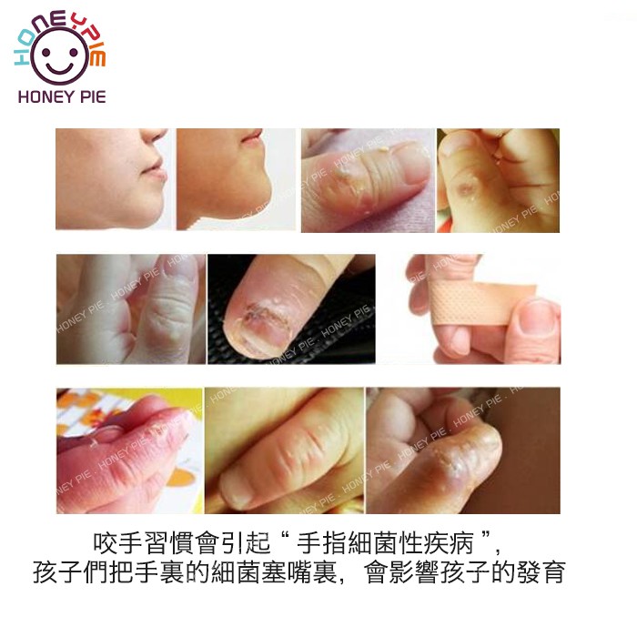 Dụng Cụ Chỉnh Hình Ngón Tay Khi Cắn Tiện Dụng