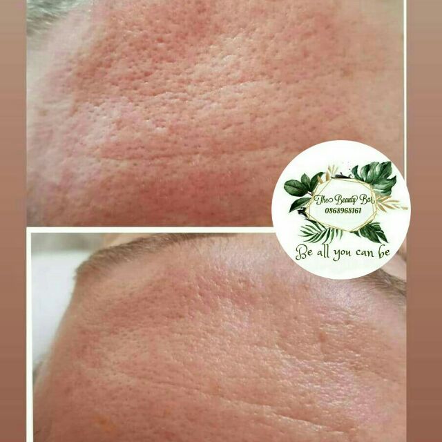 Máy siêu mài mòn kim cương cầm tay HoMedics MDA-100EU công nghệ Microdermabrasion