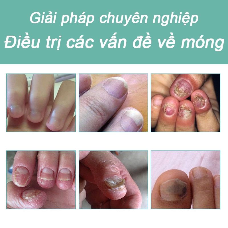 Kem Dưỡng Móng Phục Hồi Móng Nấm 15g- Móng Hư Tổn Móng kháng khuẩn chân loại nấm móng gãy móng chống các bệnh nấm móng nhanh dùng nam và nữ Móng kháng khuẩn