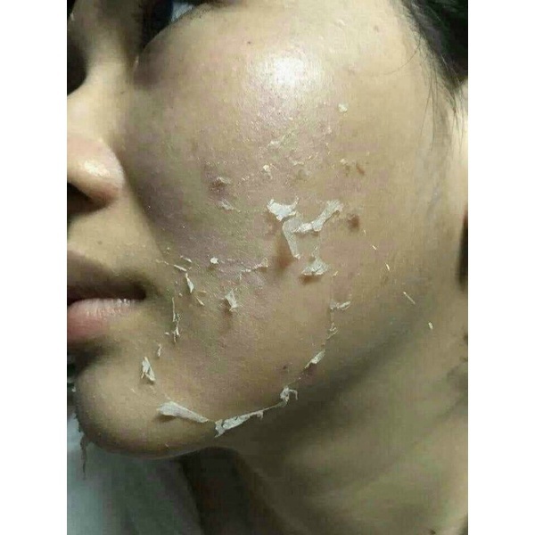 Thay da sinh học Peel da vi tảo se khít lỗ chân lông tẩy tế bào chết sạm nám tàn nhang tái tạo da ngăn ngừa mụn HANAPU