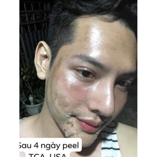 Peel da TCA 50% đánh bay mụn, rỗ, thâm, nám, lỗ chân lông to, da dầu, rạn, sẹo lồi, làm trắng mịn da