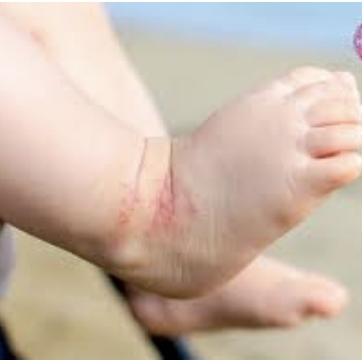 Kem dexeryl làm hết chàm sữa nứt nẻ mẩn đỏ ngứa viêm da cơ địa eczema cho bé và người lớn