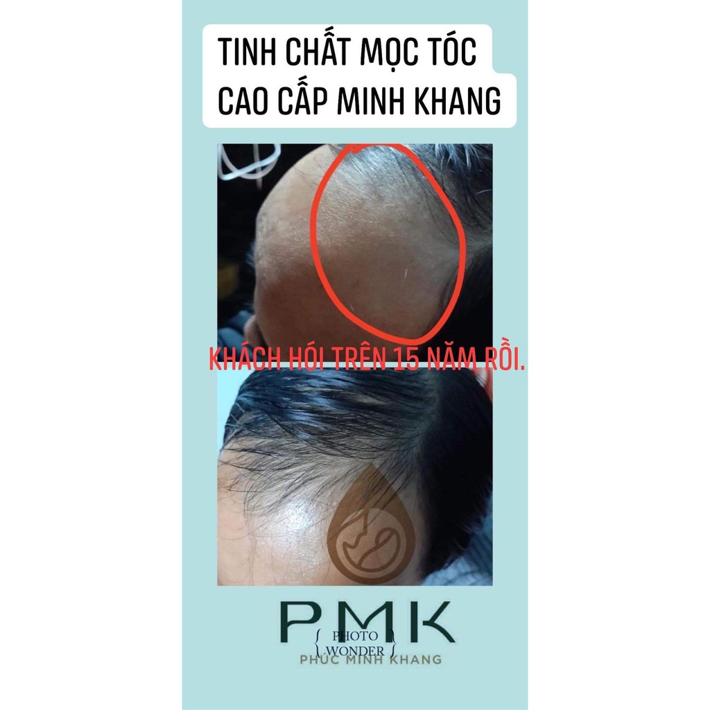 Tinh chất phục hồi tóc hư tổn, khích thích mọc tóc, hết rụng tóc, hết nấm ngứa, sạch gàu Minh Khang [Hàng chính hãng]