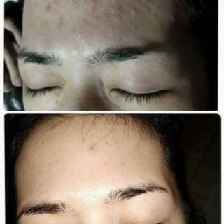 Ủ thảo dược humnile