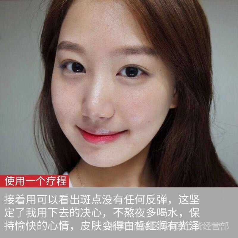 Bộ kem làm trắng xóa thâm đốm sắc tố melanin tàn nhang trẻ hóa da sáng và buổi tối
