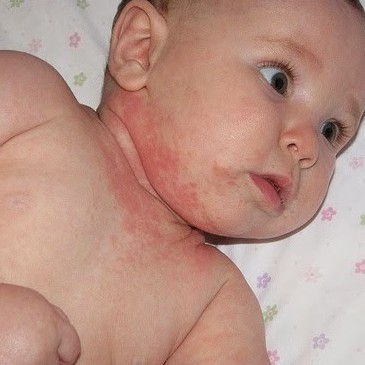 Kem chàm Aveeno Baby Eczema 141gr cho bé