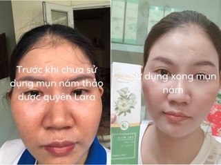 Siêu phẩm làm mờ nám, tàn nhang và mụn