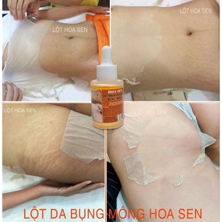 Lột Da Mông Bụng Hết Thâm Đen Mờ Rạn Nứt(tặng kem dưỡng)che tên