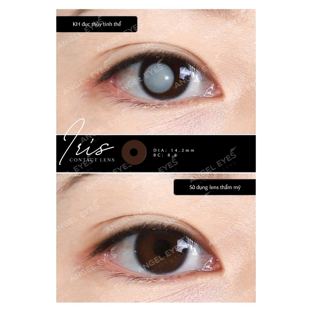 Kính Áp Tròng / Lens mắt THẨM MỸ che khuyết điểm khi bị tật 1 bên mắt