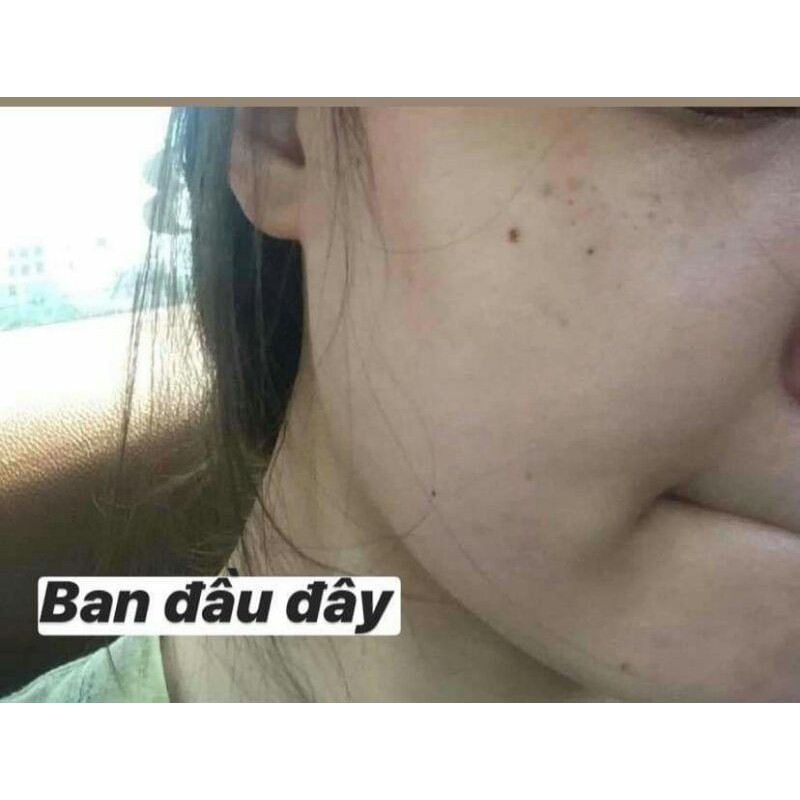 Tinh chất serum trị nám, tàn nhang trắng da ILYANG Hàn Quốc