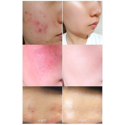 Kem dưỡng hỗ trợ giảm mụn 30 ngày Some By Mi AHABHAPHA 30 Days Miracle Cream 60g