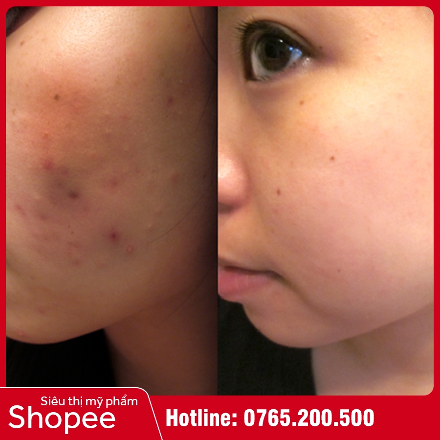 Kem Mờ Thâm Mụn Medi White - Medi Spotless - Mờ Thâm Mụn Chỉ Sau 2 Tuần | BigBuy360 - bigbuy360.vn