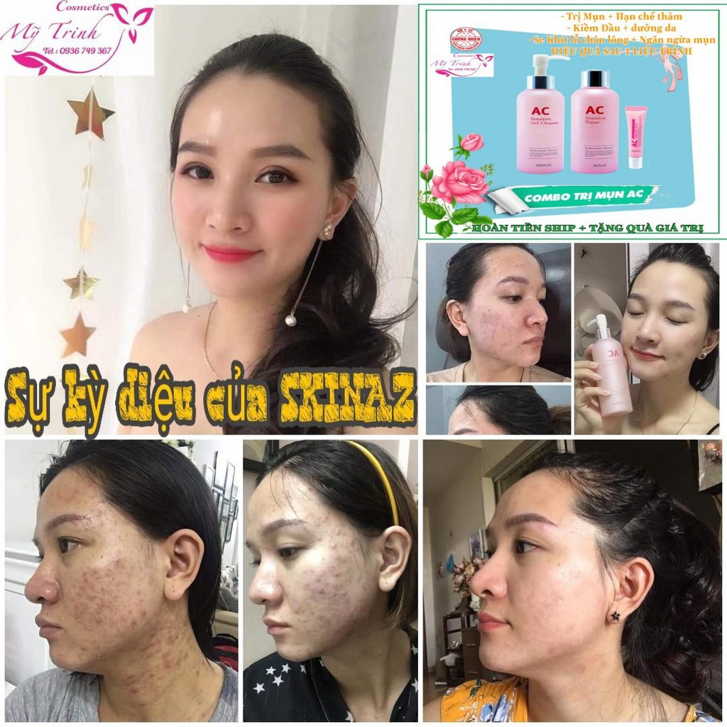 Bộ DƯỠNG DA MỤN AC, DA NHẠY CẢM, DẦU NHỜN SKINAZ