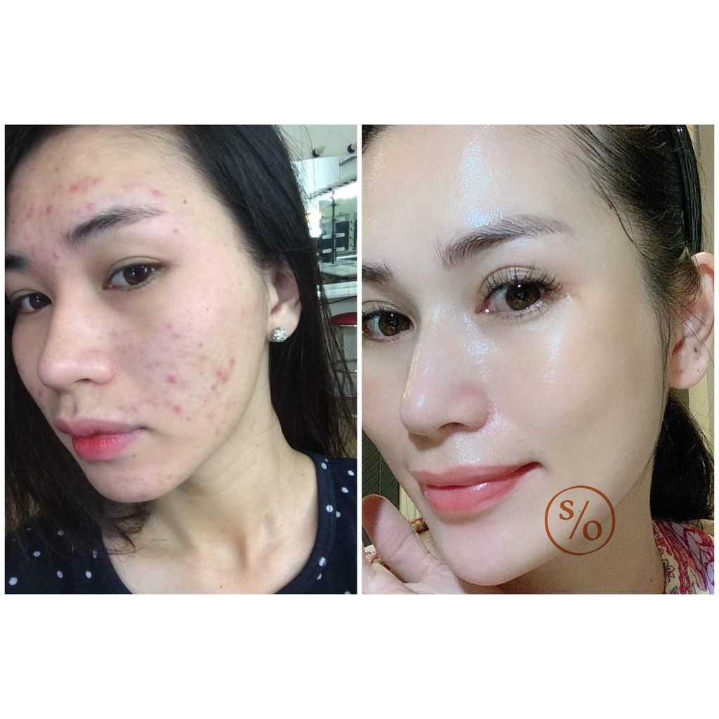GIẢI PHÁP NGỪA MỤN NÁM SẸO RỖ TÁI TẠO LÀN DA MỚI SKIN RENEWAL SOLUTION BẰNG THẢO DƯỢC DÀNH CHO MỌI LOẠI DA | BigBuy360 - bigbuy360.vn