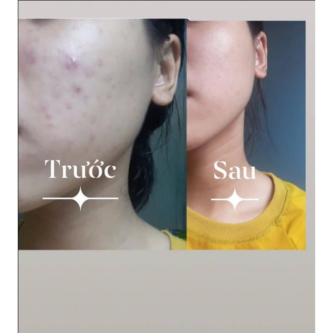 Serum 7days giảm mụn, mờ thâm nám 10ml.