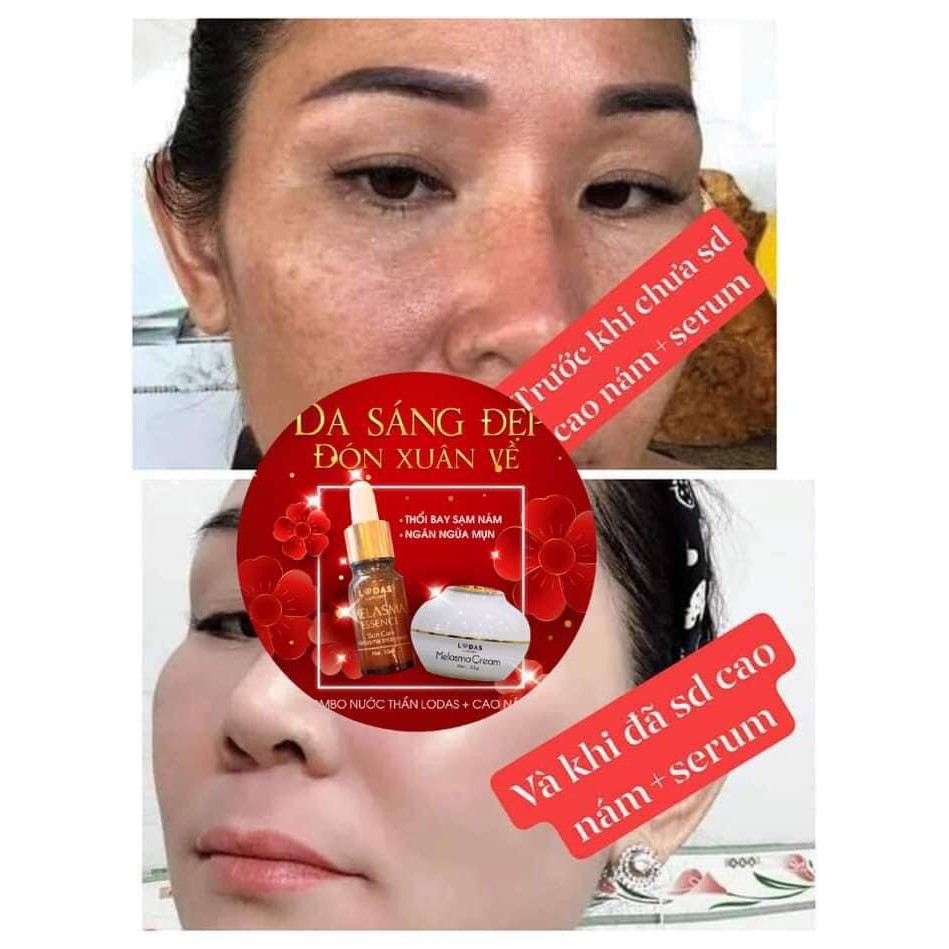 Cao Nám Lodas Cream - loại bỏ vết sạm nám giúp da bạn trở nên trắng hồng rạng rỡ