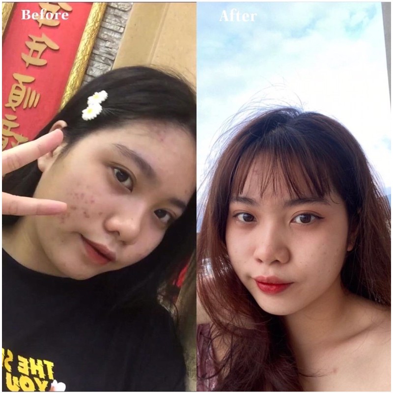 TURMERIC EXTRACT -ĐÁNH BAY MỤN ẨN VÀ CÁC LOẠI MỤN | BigBuy360 - bigbuy360.vn