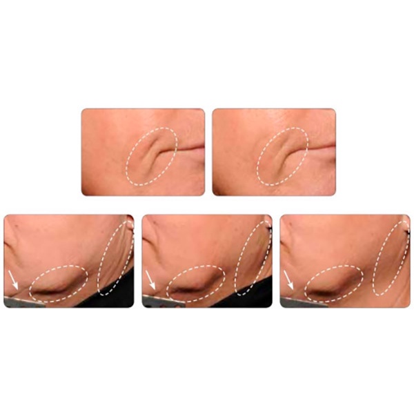 (ECO)Serum LICA 3D-LIFTING nâng cơ chỉnh hình thon gọn khuôn mặt xóa nếp nhăn hiệu ứng Cấy Chỉ vàng chống lão hóa mạnh | BigBuy360 - bigbuy360.vn