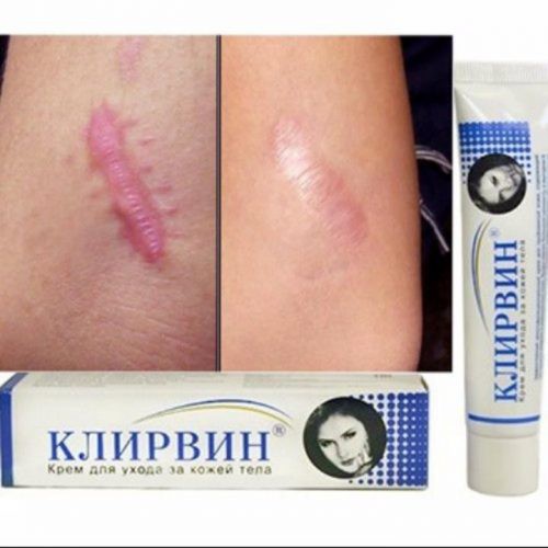 Kem sẹo  Klirvin giúp mờ sẹo lồi, lõm, sẹo thâm chỉ trong 2 tháng Klirvin (cam kết chính hãng Nga)