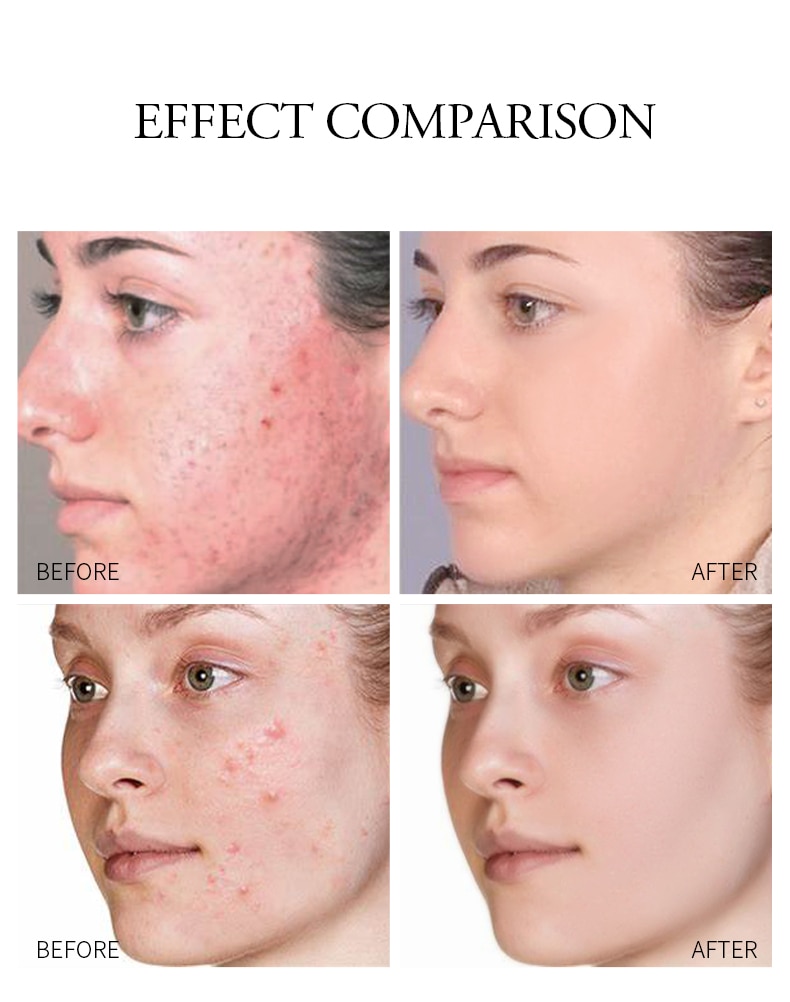 Gel hỗ trợ giảm mụn LAIKOU dưỡng ẩm làm mờ vết sẹo se khít lỗ chân lông kiềm dầu chuyên dụng cho làn da mịn màng 20g