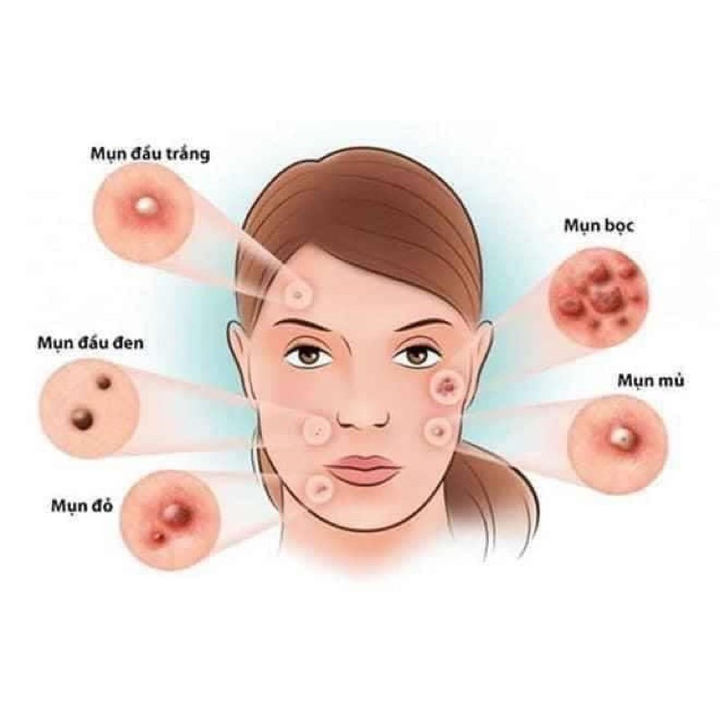 Serum mụn Lumos mẫu mới 2022 chai to | BigBuy360 - bigbuy360.vn