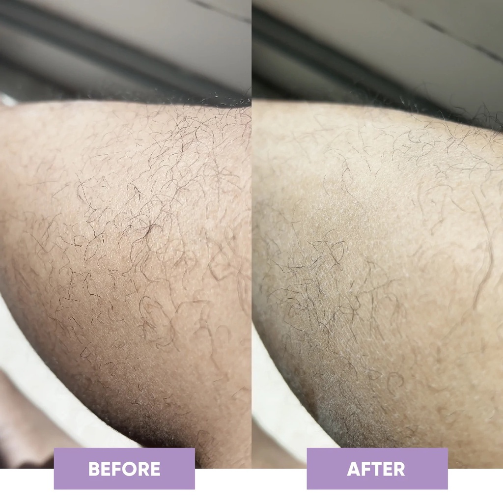 US-UK  Đá Tẩy Lông Không Đau Nano-Crystalline Misglo Cao Cấp Full Box