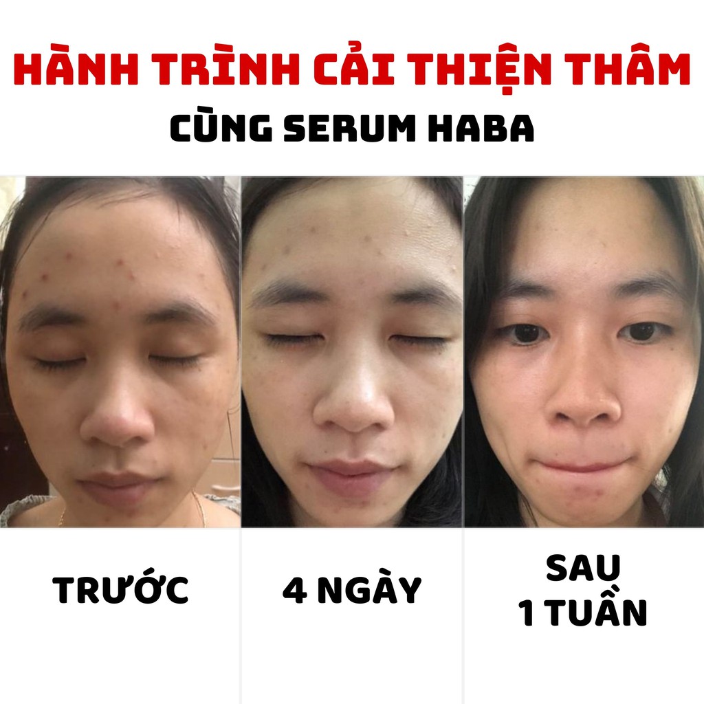 Serum Haba White Lady giảm thâm, dưỡng trắng, căng bóng da