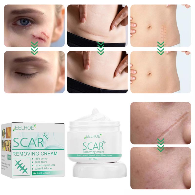 EELHOE Gel xóa sẹo Loại bỏ Sẹo mụn, Vết rạn da và Sẹo lồi Sửa chữa da