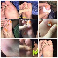 Miếng dán loại bỏ nốt chai sần và mụn cóc cho bàn chân