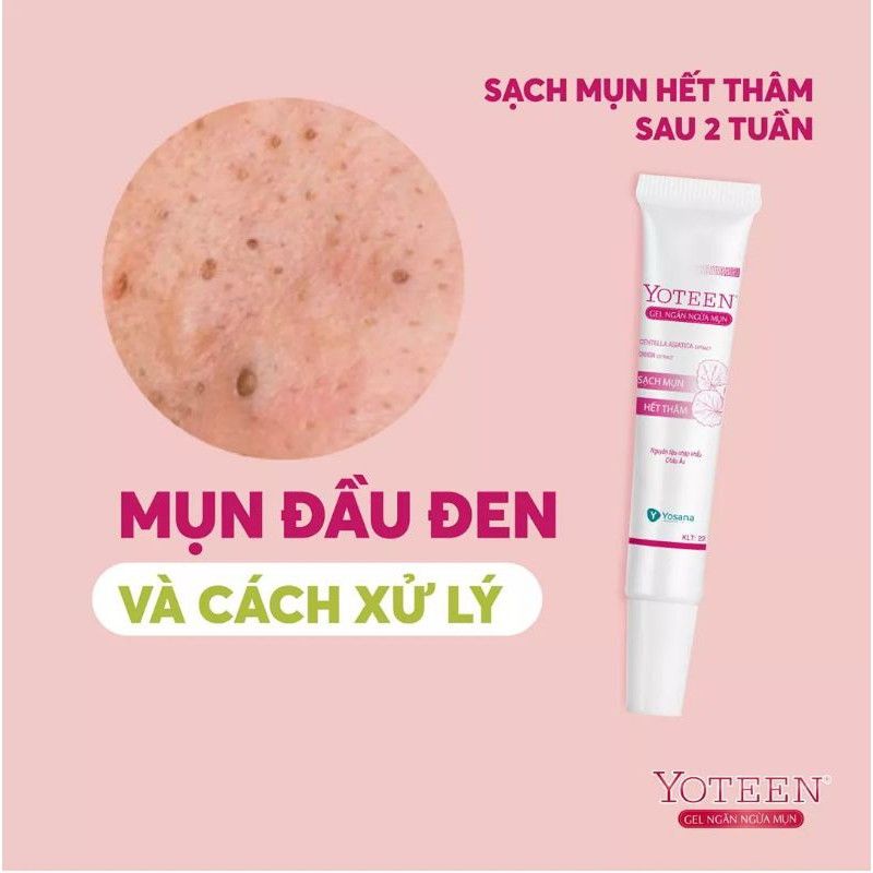 Gel bôi mụn Yoteen hỗ trợ làm sạch mụn, hết thâm, ngừa sẹo hiệu quả sau 2 tuần tube 22g