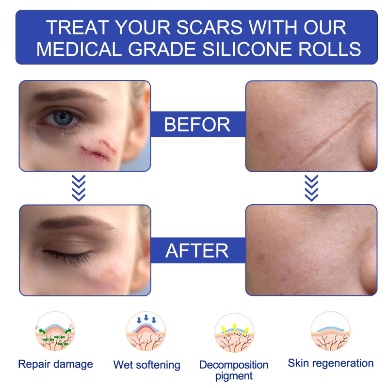 Cuộn Băng Keo Silicon 1 6in x 120in Loại Bỏ Sẹo Có Thể Tái Sử Dụng