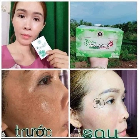 Diệp lục Colagen đẹp da hết mụn mờ thâm nám, bổ sung 1kg rau xanh