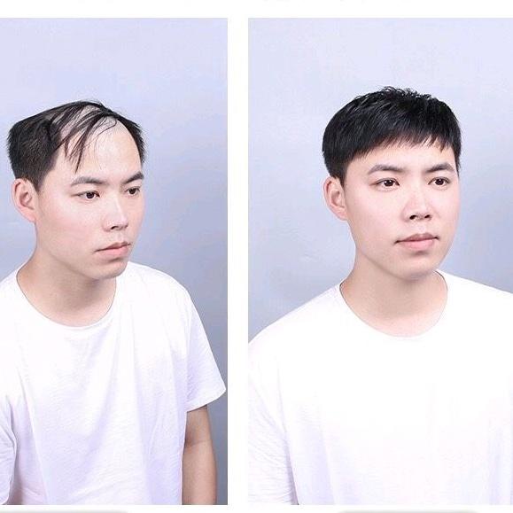 Tóc Giả Che Hói Cho Nam Phong Cách Trẻ Trung QiQiShop