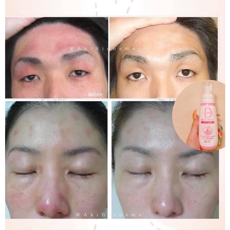 Dưỡng ẩm tạo bọt Atopia D cho da nhạy cảm nội địa Nhật✨