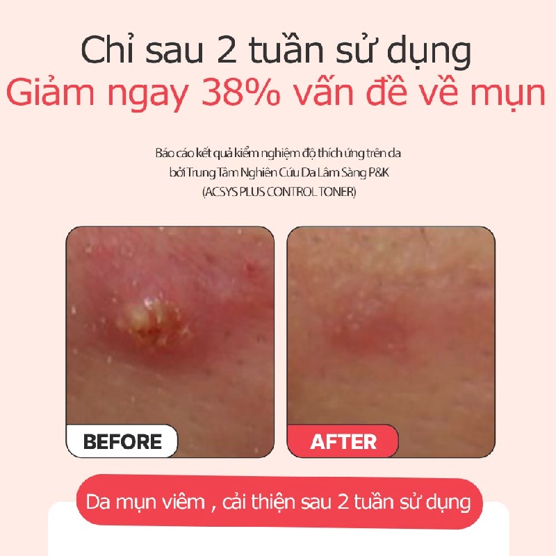 Sữa Rửa Mặt Cho Da Dầu Mụn SNP Acsys Plus Mild Cleanser Hàn Quốc Sạch Sâu Giữ Ẩm Điều Chỉnh Tiết Nhờn Ngăn Ngừa Mụn
