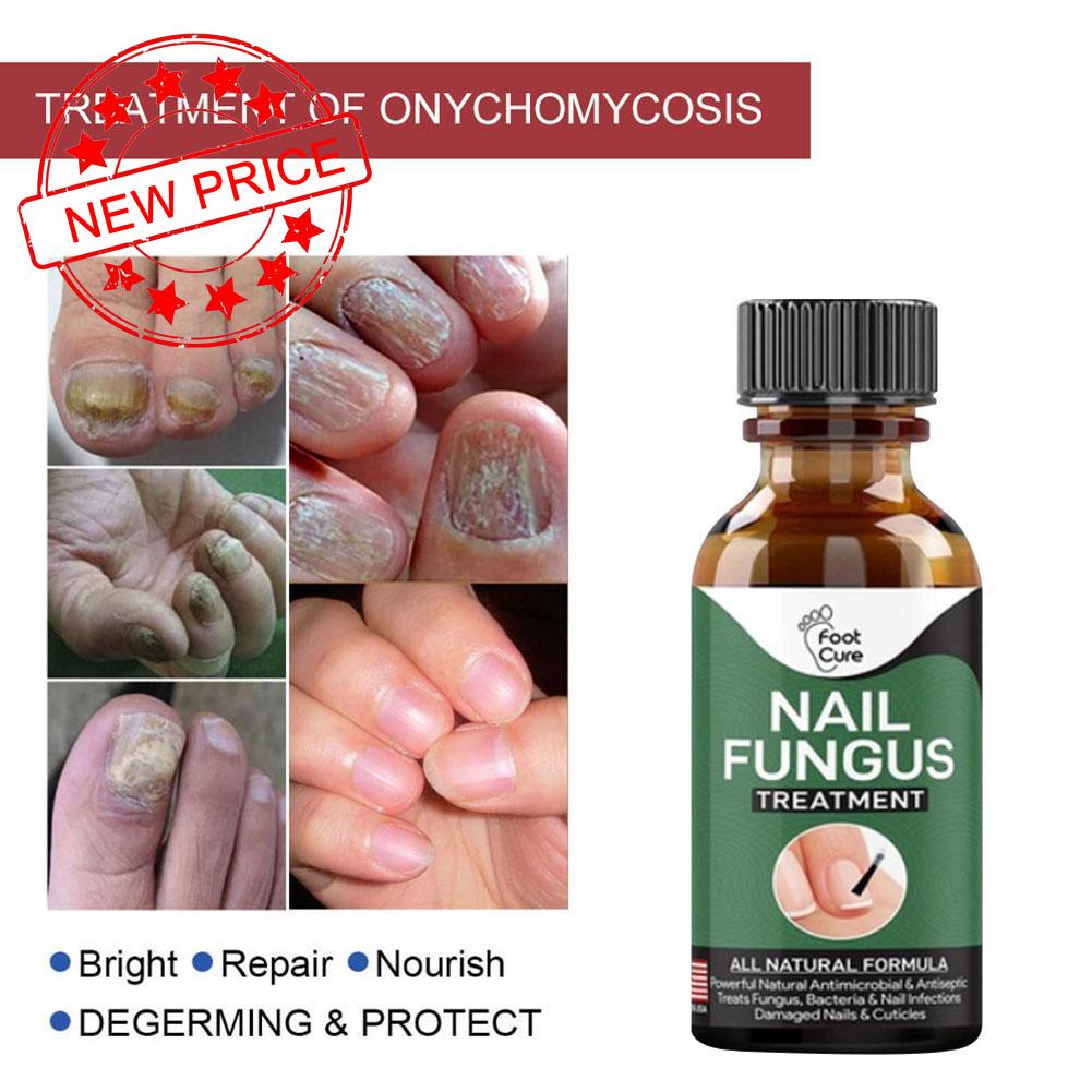 Dung Dịch Phục Hồi Móng Tay Và Chân Onychomyc T0B1 Chuyên Dụng Mới