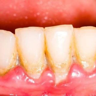 BỘT THAN TRE HOẠT TÍNH TRĂNG RĂNG ZENPALI ( Tặng 1tuyp kem đánh răng SENSODYNE )
