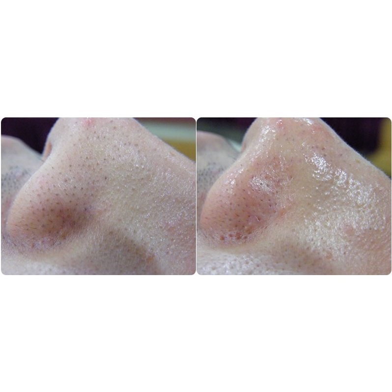 MÁY CHĂM SÓC DA AQUA PEEL  - Hàng Chính Hãng