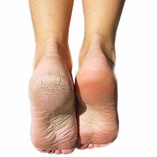 Kem trị nứt gót chân Nha Kpem