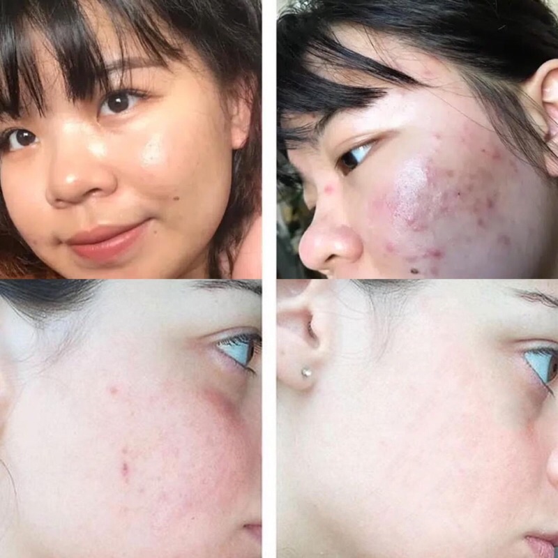 Sửa Rửa Mặt giảm mụn và dầu ACNE Some By Mi AHA-BHA-PHA 30 Days Miracle Acne Clear Foam