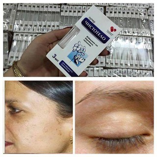 Tẩy nốt ruồi nga