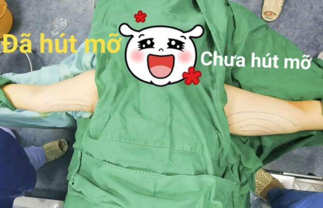 Gen nịch bắp tay giảm mỡ cánh tay | BigBuy360 - bigbuy360.vn