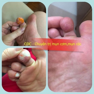 Dán mụn cóc 6 miếng/hộp