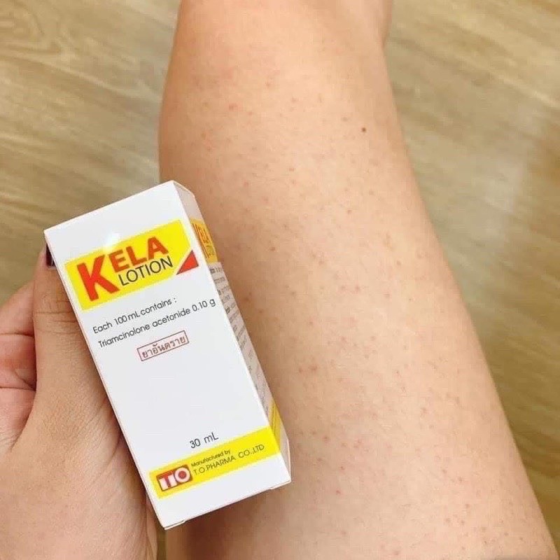 LOTION KELLA VIÊM LỖ CHÂN LÔNG,  VIEM DA THÁI LAN